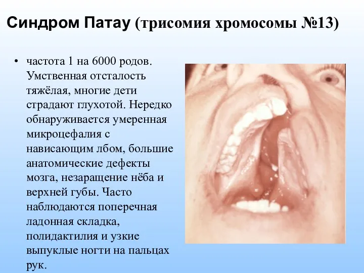 Синдром Патау (трисомия хромосомы №13) частота 1 на 6000 родов.