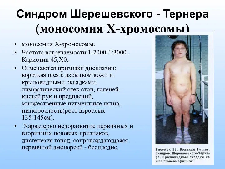 Синдром Шерешевского - Тернера (моносомия X-хромосомы) моносомия X-хромосомы. Частота встречаемости