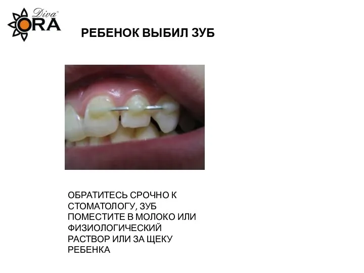 РЕБЕНОК ВЫБИЛ ЗУБ ОБРАТИТЕСЬ СРОЧНО К СТОМАТОЛОГУ, ЗУБ ПОМЕСТИТЕ В