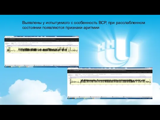Выявлены у испытуемого с особенность ВСР, при расслабленном состоянии появляются признаки аритмии