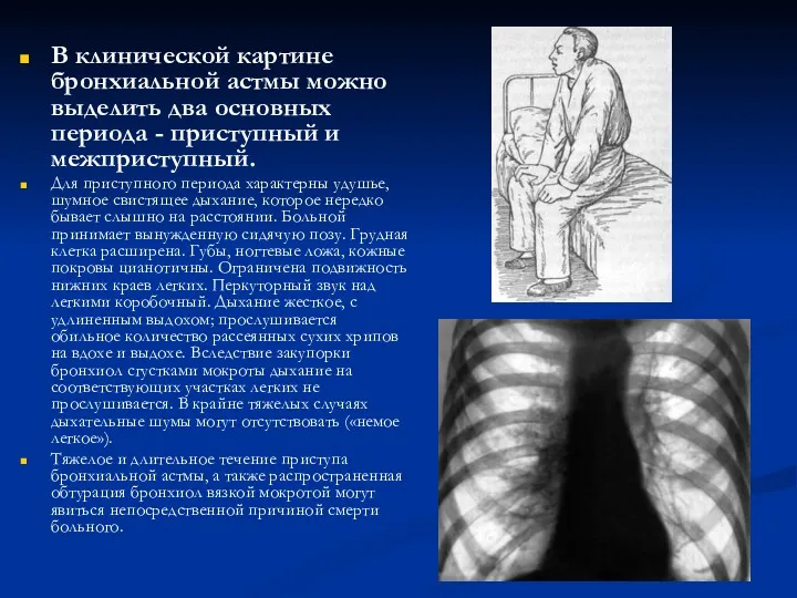 В клинической картине бронхиальной астмы можно выделить два основных периода - приступный и