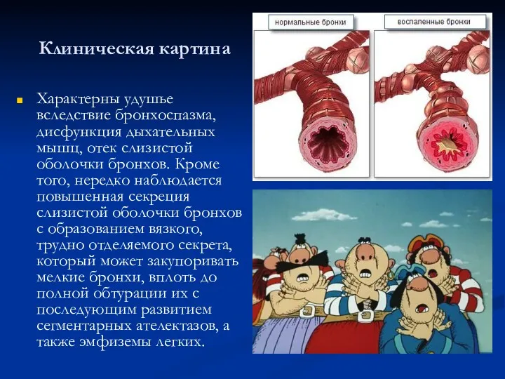 Клиническая картина Характерны удушье вследствие бронхоспазма, дисфункция дыхательных мышц, отек слизистой оболочки бронхов.