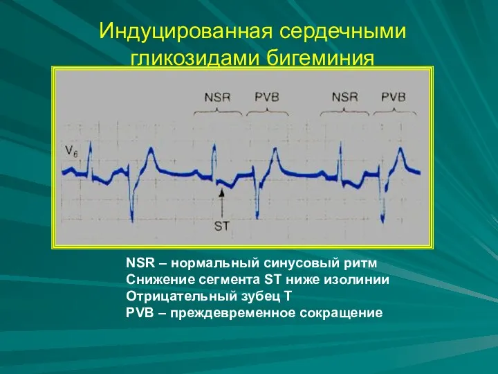 Индуцированная сердечными гликозидами бигеминия NSR – нормальный синусовый ритм Снижение