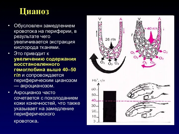Цианоз Обусловлен замедлением кровотока на периферии, в результате чего увеличивается экстракция кислорода тканями.