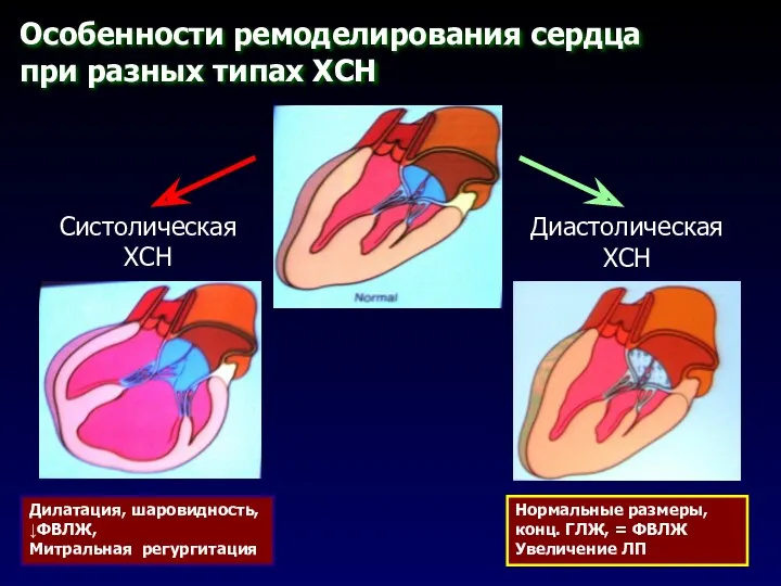 Особенности ремоделирования сердца при разных типах ХСН