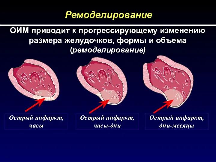 ОИМ приводит к прогрессирующему изменению размера желудочков, формы и объема (ремоделирование) Ремоделирование Острый