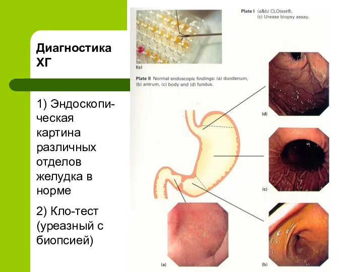 Диагностика ХГ 1) Эндоскопи-ческая картина различных отделов желудка в норме 2) Кло-тест (уреазный с биопсией)