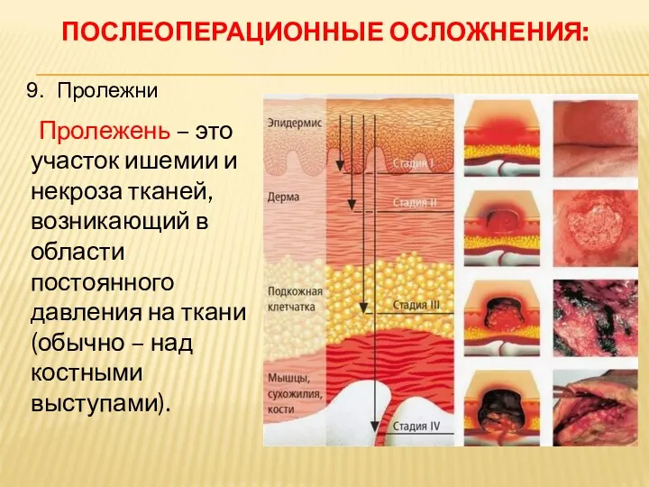 ПОСЛЕОПЕРАЦИОННЫЕ ОСЛОЖНЕНИЯ: Пролежень – это участок ишемии и некроза тканей,