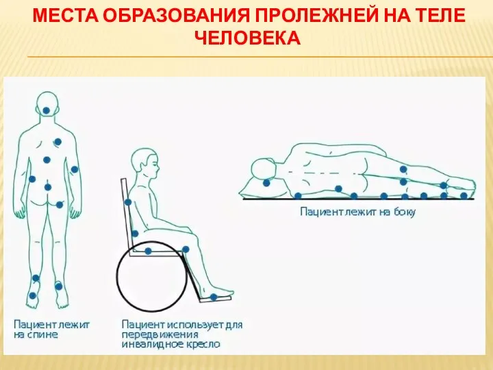 МЕСТА ОБРАЗОВАНИЯ ПРОЛЕЖНЕЙ НА ТЕЛЕ ЧЕЛОВЕКА