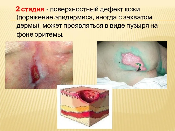 2 стадия - поверхностный дефект кожи (поражение эпидермиса, иногда с