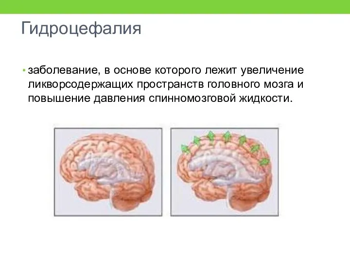 Гидроцефалия заболевание, в основе которого лежит увеличение ликворсодержащих пространств головного мозга и повышение давления спинномозго­вой жидкости.