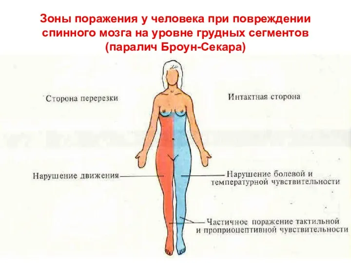 Зоны поражения у человека при повреждении спинного мозга на уровне грудных сегментов (паралич Броун-Секара)