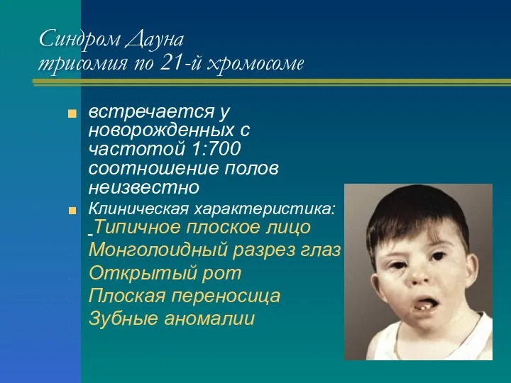 Синдром Дауна трисомия по 21-й хромосоме встречается у новорожденных с