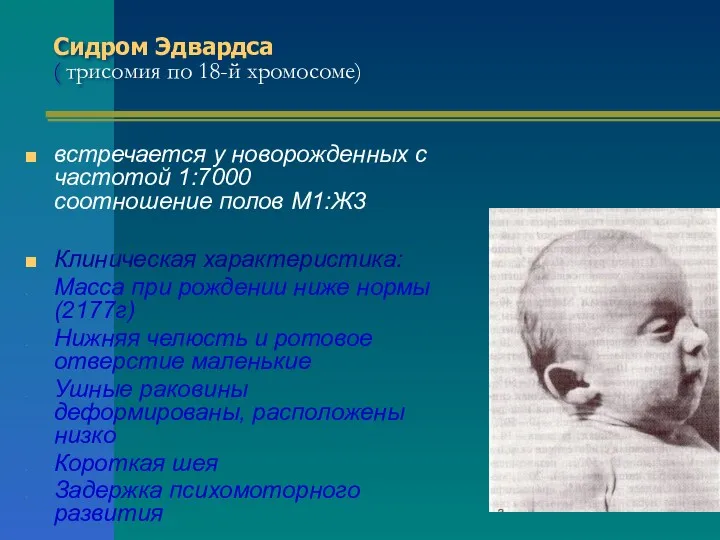 Сидром Эдвардса ( трисомия по 18-й хромосоме) встречается у новорожденных