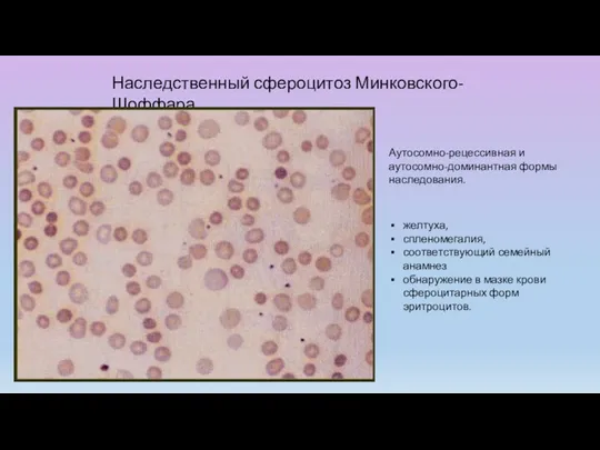 Наследственный сфероцитоз Минковского-Шоффара желтуха, спленомегалия, соответствующий семейный анамнез обнаружение в