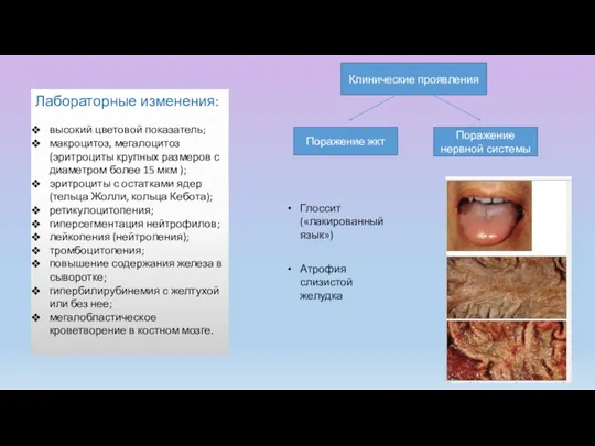 Лабораторные изменения: высокий цветовой показатель; макроцитоз, мегалоцитоз (эритроциты крупных размеров