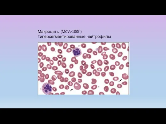 Макроциты (MCV>100fl) Гиперсегментированные нейтрофилы