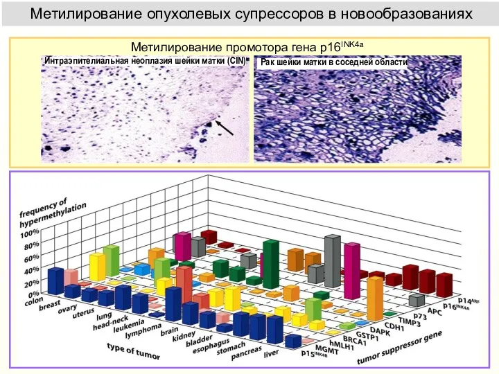 Метилирование опухолевых супрессоров в новообразованиях Метилирование промотора гена p16INK4a
