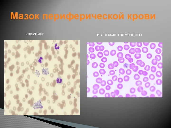 Мазок периферической крови клампинг гигантские тромбоциты