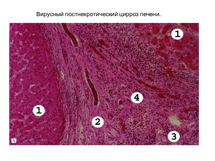 Вирусный постнекротический цирроз печени.