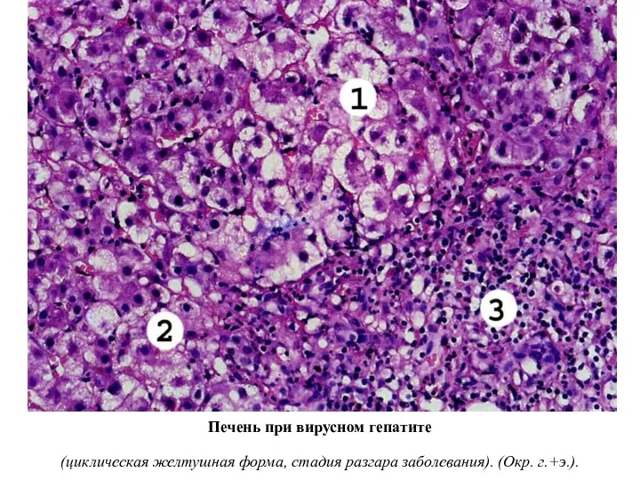 Печень при вирусном гепатите (циклическая желтушная форма, стадия разгара заболевания). (Окр. г.+э.).