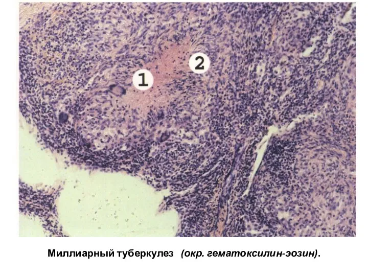 Миллиарный туберкулез (окр. гематоксилин-эозин).