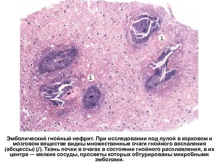 Эмболический гнойный нефрит. При исследовании под лупой в корковом и