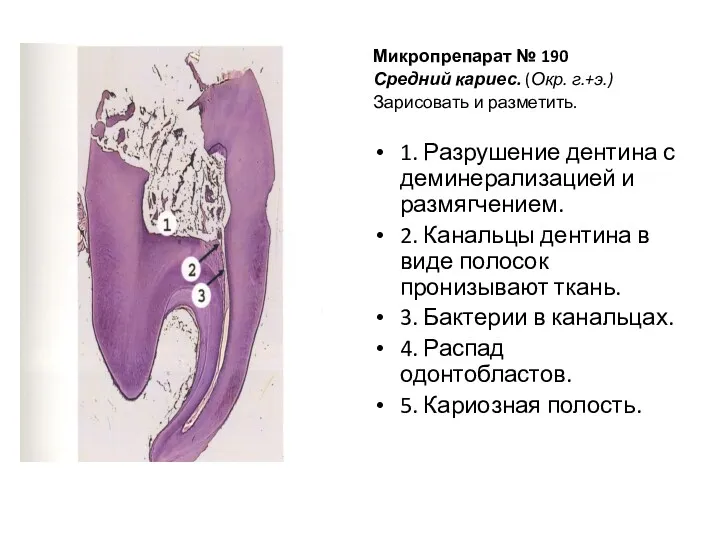 Микропрепарат № 190 Средний кариес. (Окр. г.+э.) Зарисовать и разметить.