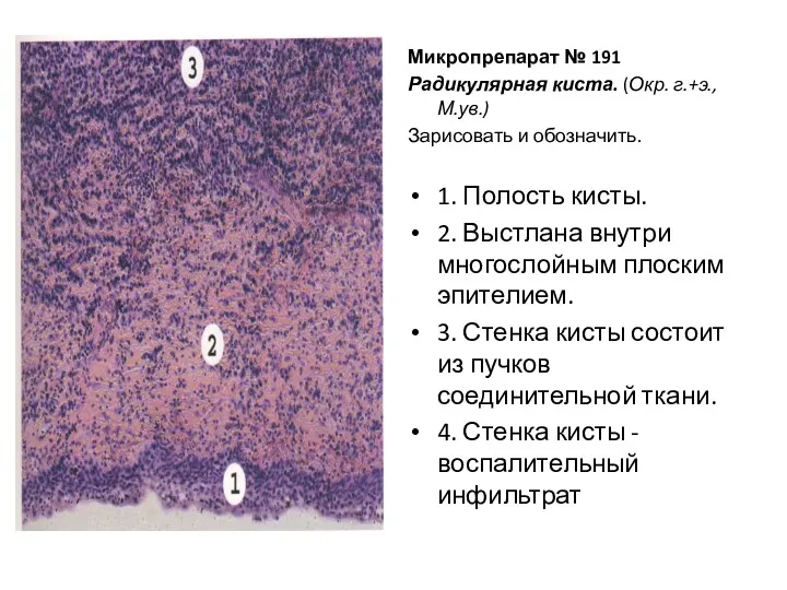 Микропрепарат № 191 Радикулярная киста. (Окр. г.+э., М.ув.) Зарисовать и