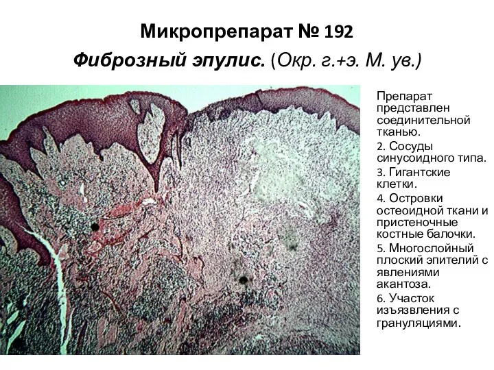 Микропрепарат № 192 Фиброзный эпулис. (Окр. г.+э. М. ув.) Препарат
