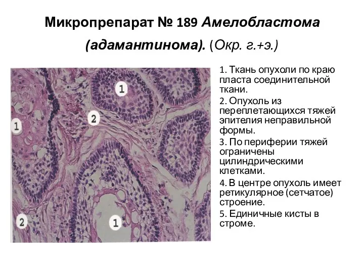 Микропрепарат № 189 Амелобластома (адамантинома). (Окр. г.+э.) 1. Ткань опухоли