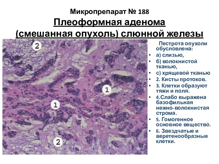 Микропрепарат № 188 Плеоформная аденома (смешанная опухоль) слюнной железы .