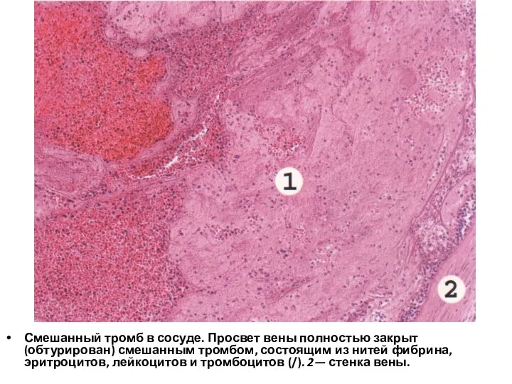 Смешанный тромб в сосуде. Просвет вены полностью закрыт (обтурирован) смешанным