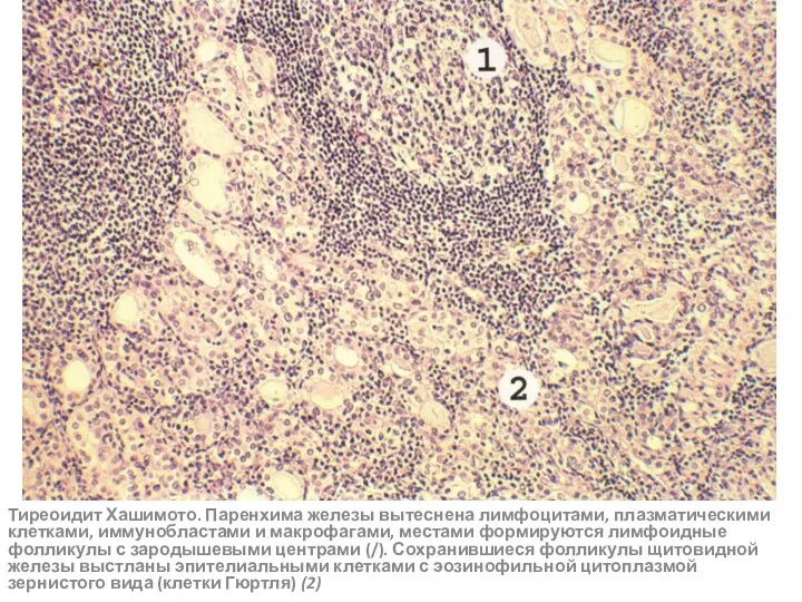 Тиреоидит Хашимото. Паренхима железы вытеснена лимфоцитами, плазматическими клетками, иммунобластами и