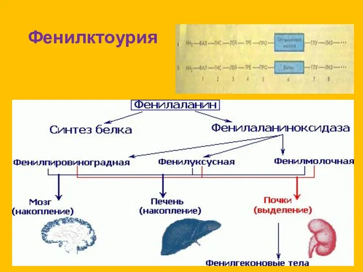 Фенилктоурия