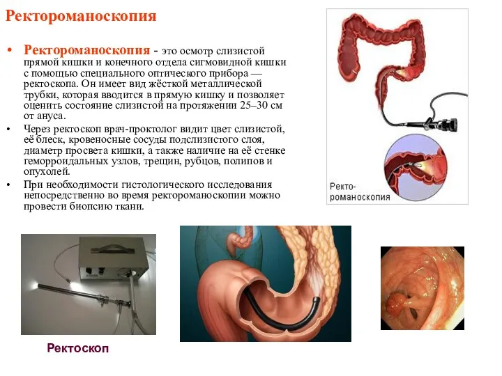 Ректороманоскопия Ректороманоскопия - это осмотр слизистой прямой кишки и конечного