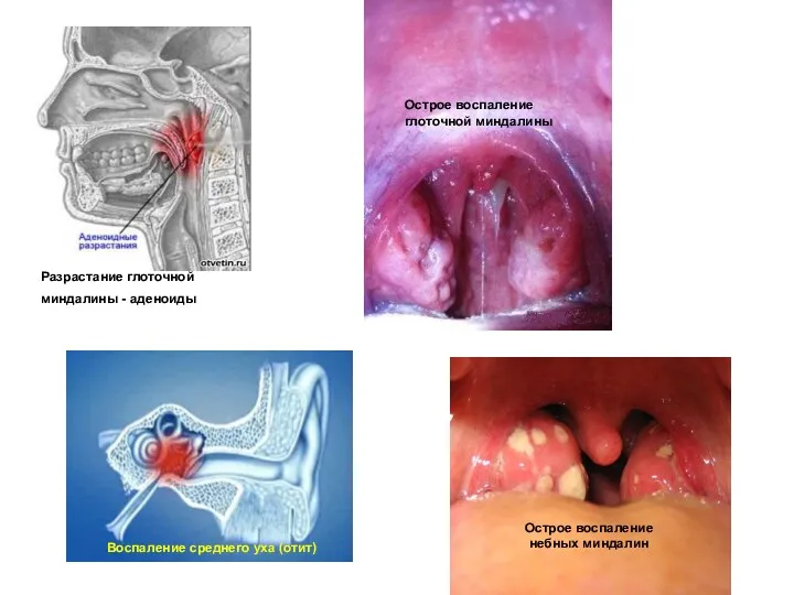 Острое воспаление глоточной миндалины Острое воспаление небных миндалин Воспаление среднего
