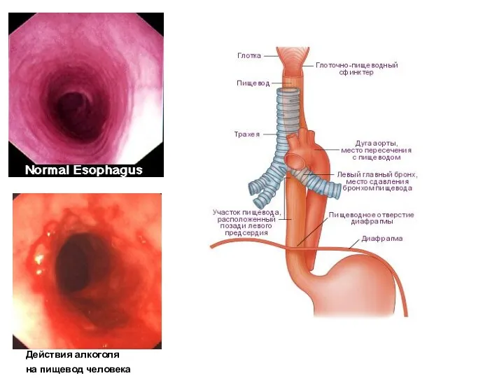 Действия алкоголя на пищевод человека
