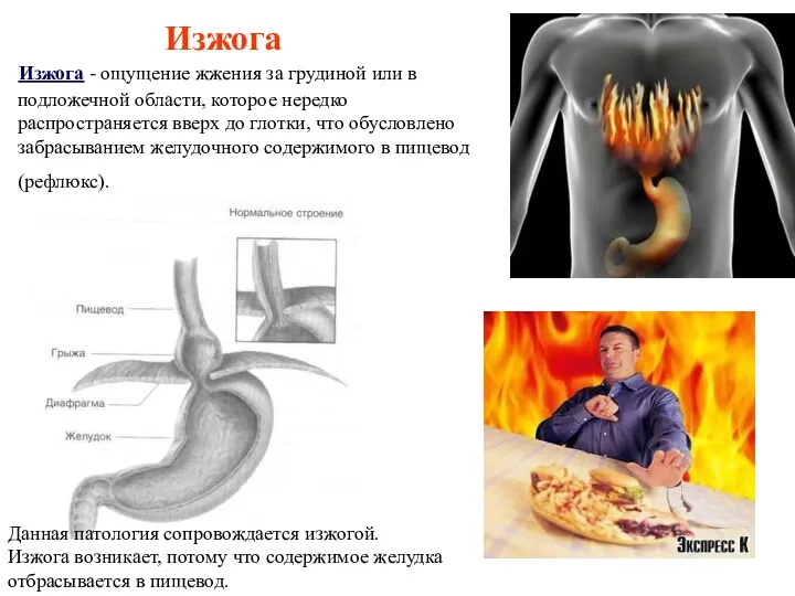 Изжога Изжога - ощущение жжения за грудиной или в подложечной