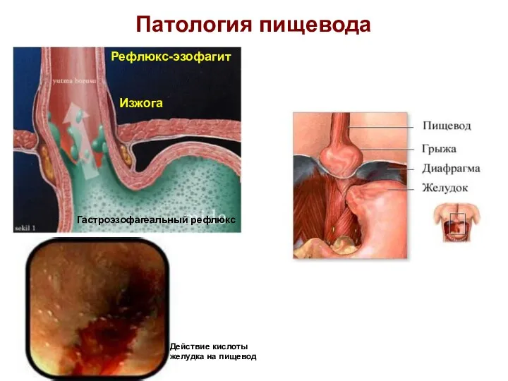 Патология пищевода Гастроэзофагеальный рефлюкс Действие кислоты желудка на пищевод Изжога Рефлюкс-эзофагит