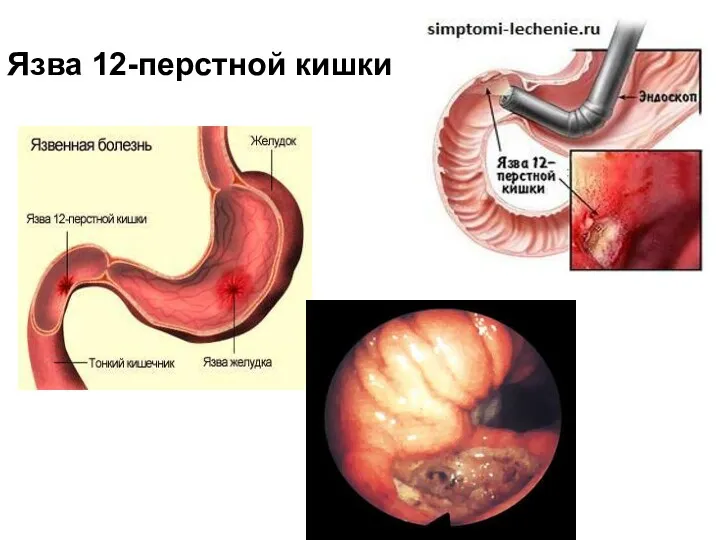 Язва 12-перстной кишки