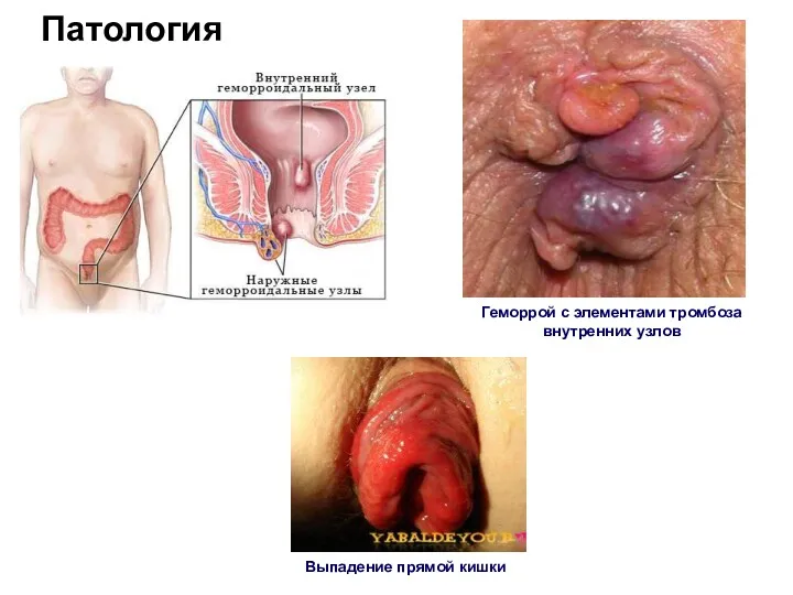 Патология Геморрой с элементами тромбоза внутренних узлов Выпадение прямой кишки