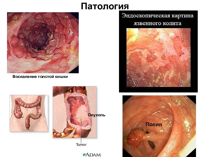 Патология Воспаление толстой кишки Опухоль Полип