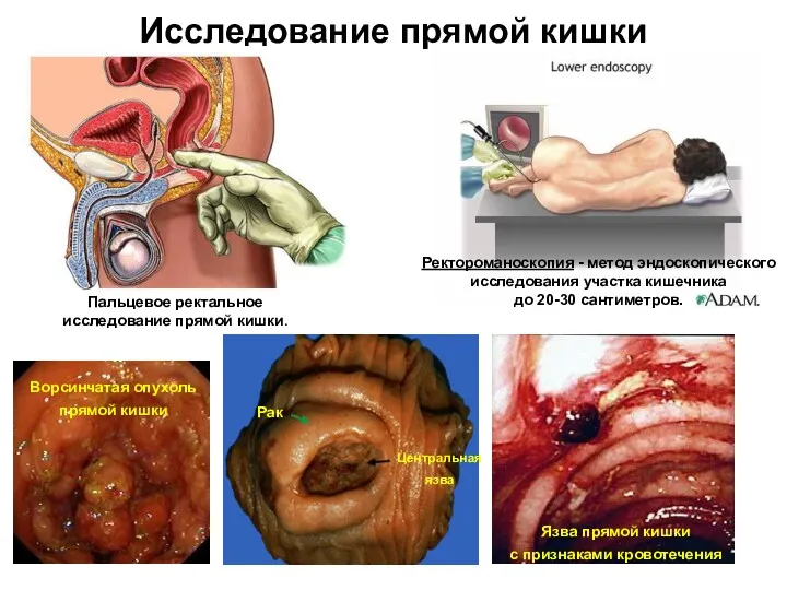 Исследование прямой кишки Пальцевое ректальное исследование прямой кишки. Ректороманоскопия -