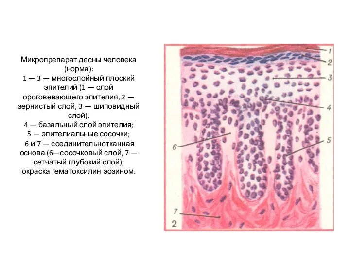 Микропрепарат десны человека (норма): 1 — 3 — многослойный плоский эпителий (1 —