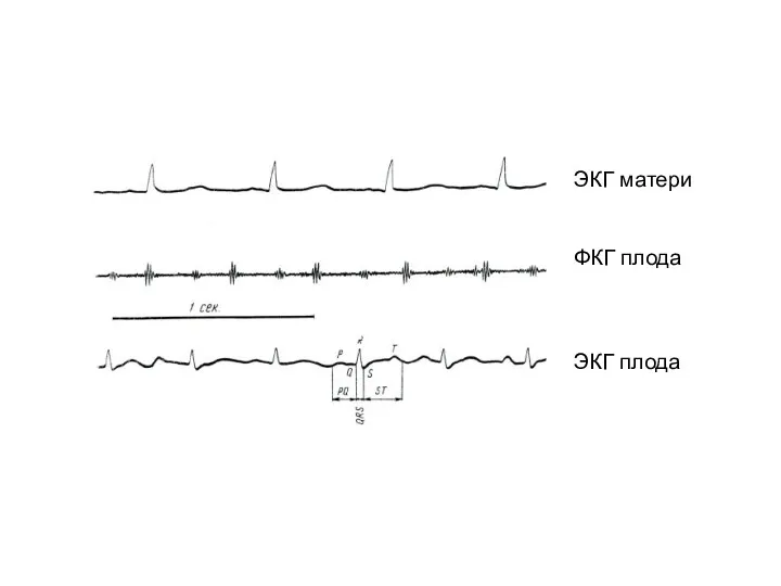 ЭКГ матери ФКГ плода ЭКГ плода