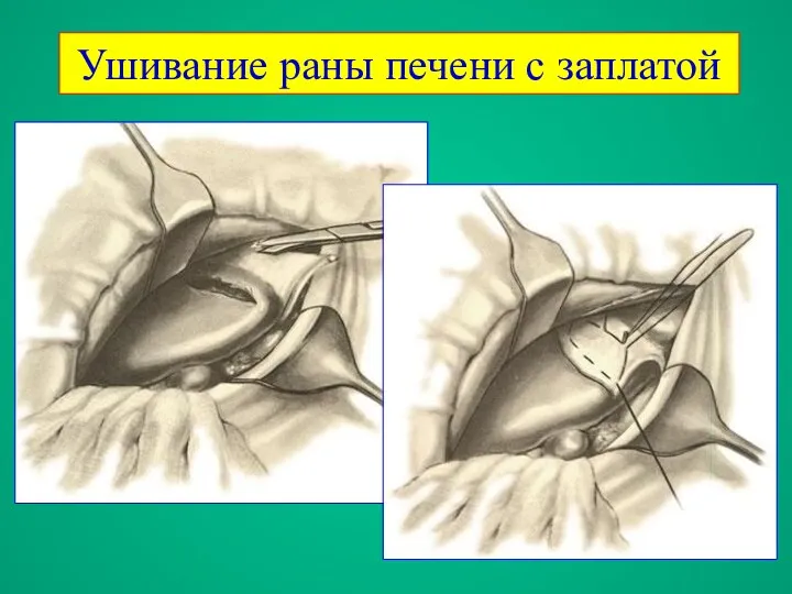 Ушивание раны печени с заплатой