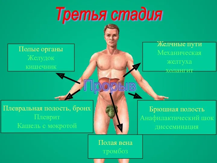 Третья стадия Прорыв Желчные пути Механическая желтуха холангит Брюшная полость