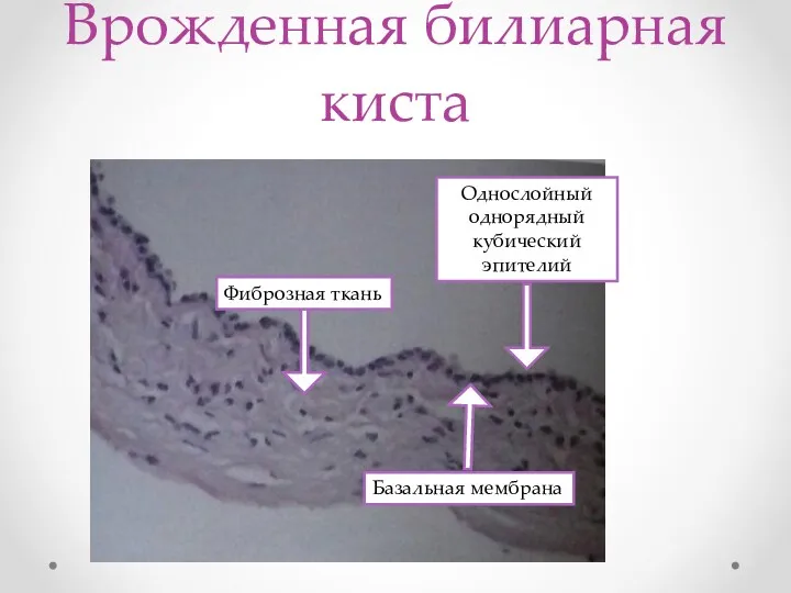 Врожденная билиарная киста Однослойный однорядный кубический эпителий Фиброзная ткань Базальная мембрана