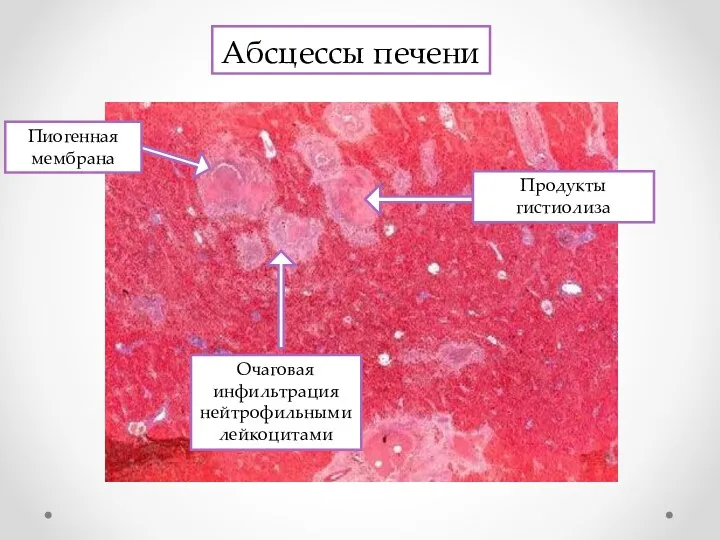 Абсцессы печени Очаговая инфильтрация нейтрофильными лейкоцитами Продукты гистиолиза Пиогенная мембрана